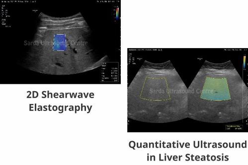 liver Elastography