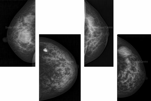 mammography