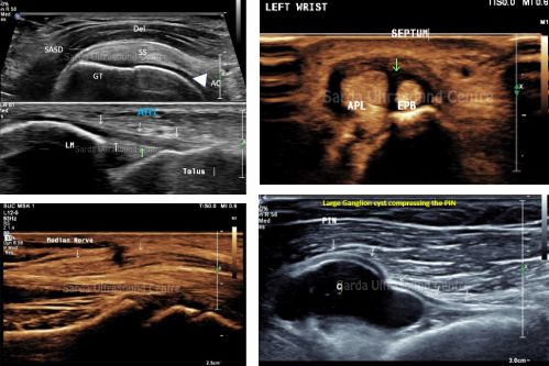 musculoskeletal ultrasound