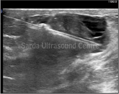 Ultrasound-Guided Interventions