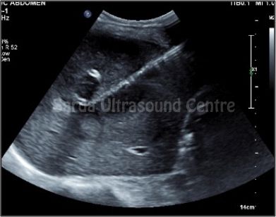 Ultrasound-Guided Interventions
