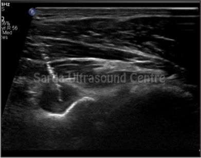 Ultrasound-Guided Interventions