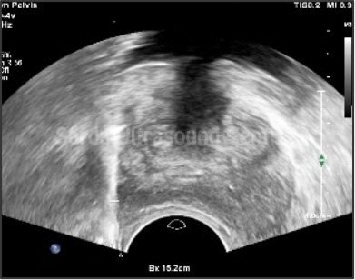 Ultrasound-Guided Interventions
